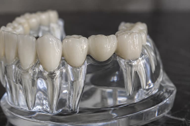 Dental bridge in Ivanhoe