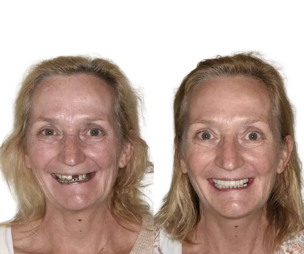 Before and after a full mouth reconstruction at Smile Connections Ivanhoe
