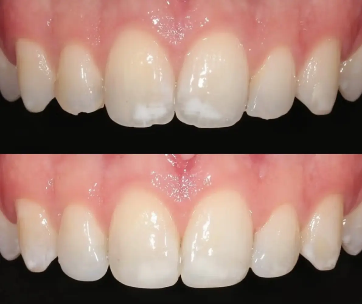 Before and after Invisalign with composite bonding at Smile Connections Ivanhoe