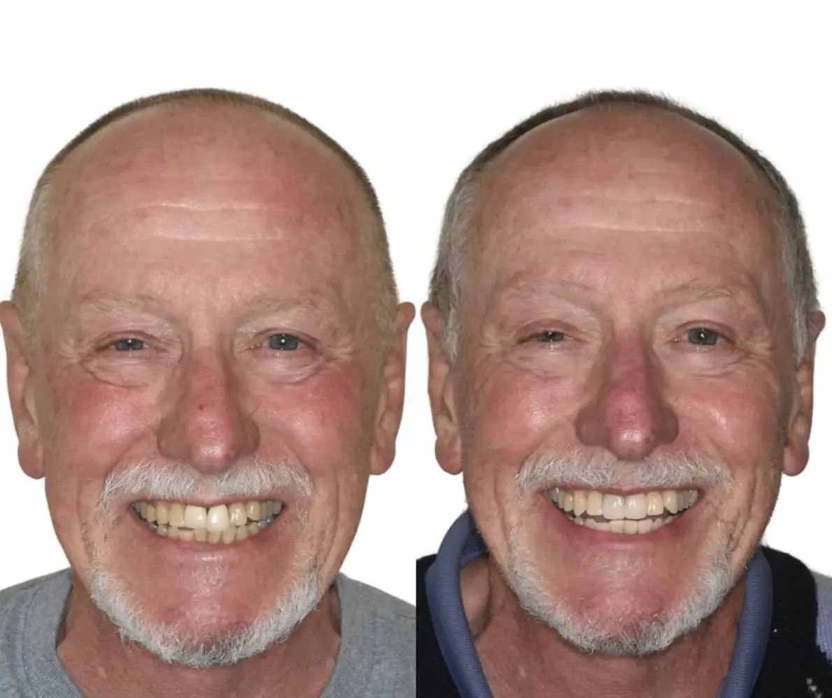 Before and after replacing old dental crowns at Smile Connections Ivanhoe