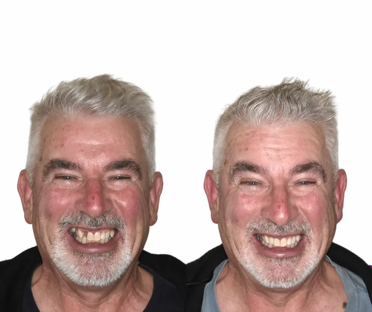 Before and after a single tooth implant at Smile Connections Ivanhoe