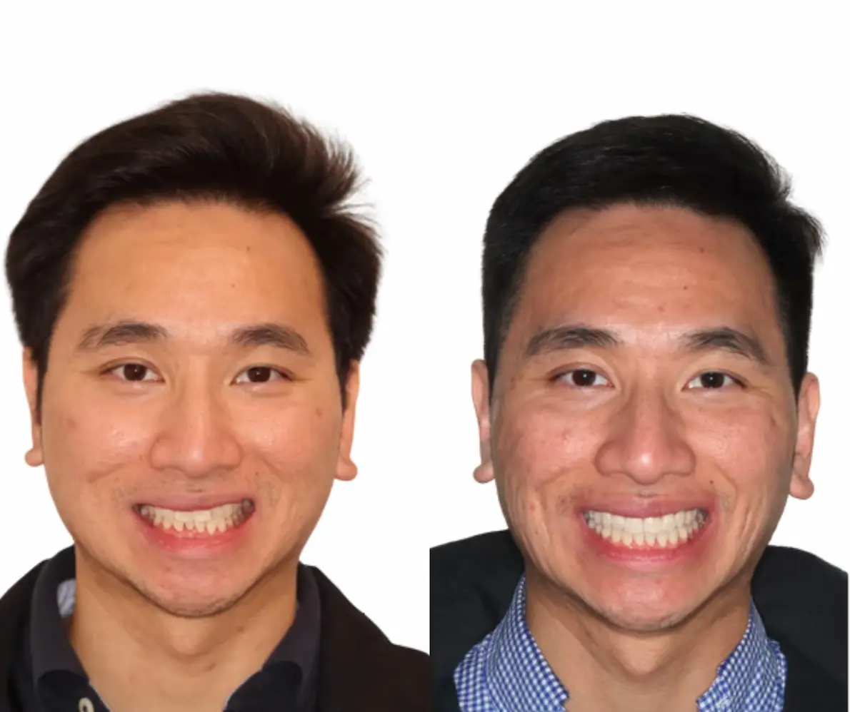 Before and after composite bonding at Smile Connections Ivanhoe