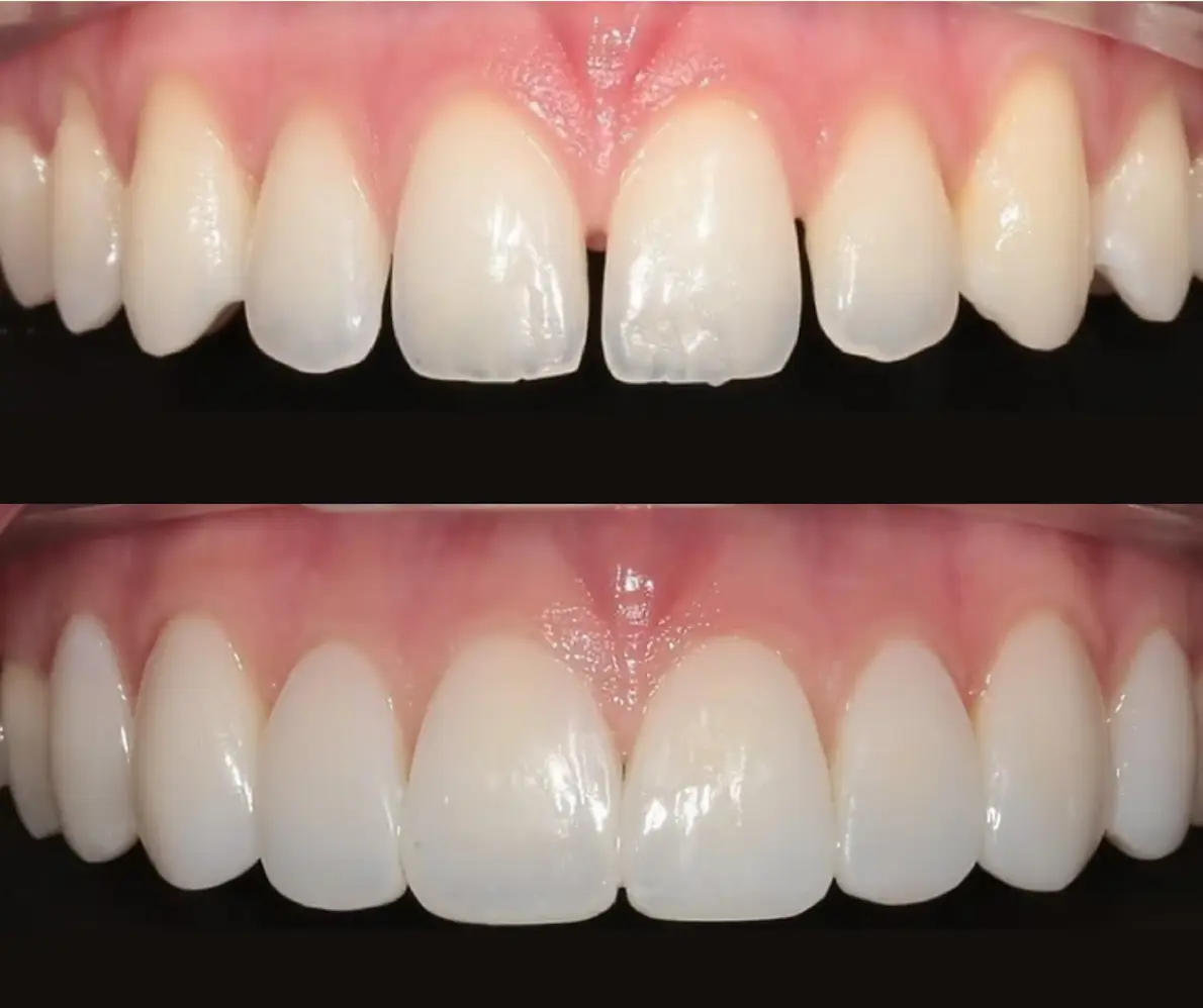 Before and after Invisalign clear braces at Smile Connections Ivanhoe