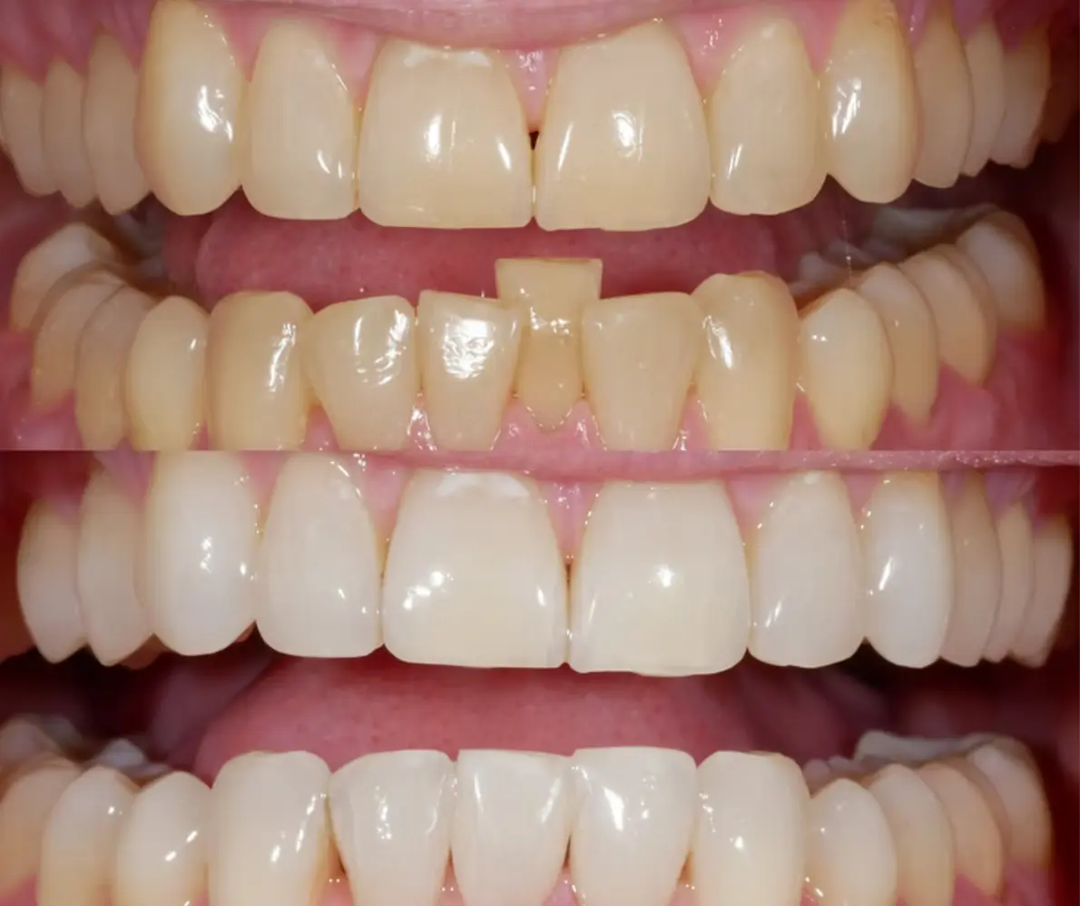 Before and after Invisalign and teeth whitening at Smile Connections Ivanhoe