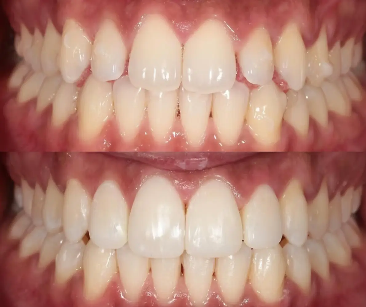 Before and after Invisalign clear braces at Smile Connections Ivanhoe