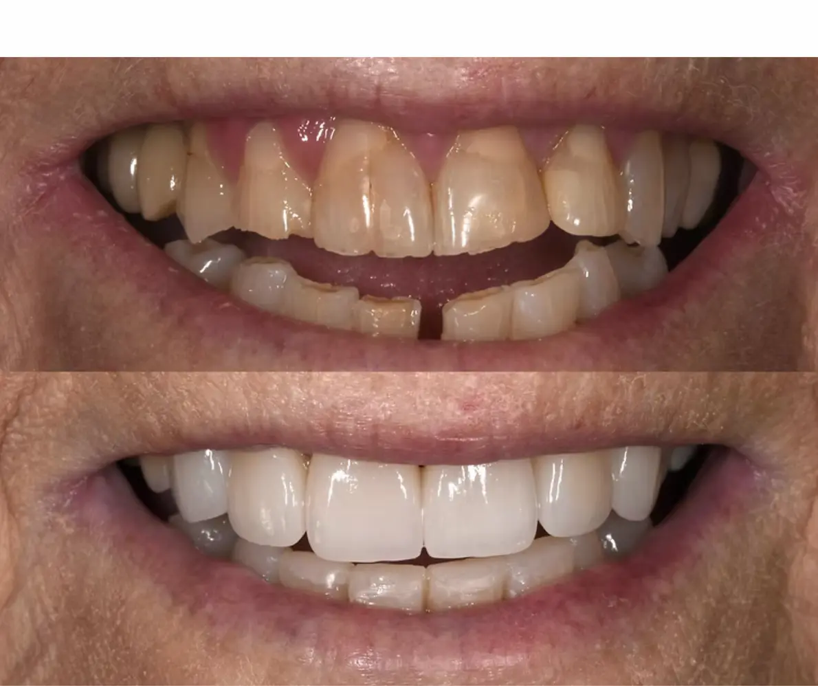 Before and after Invisalign clear braces at Smile Connections Ivanhoe