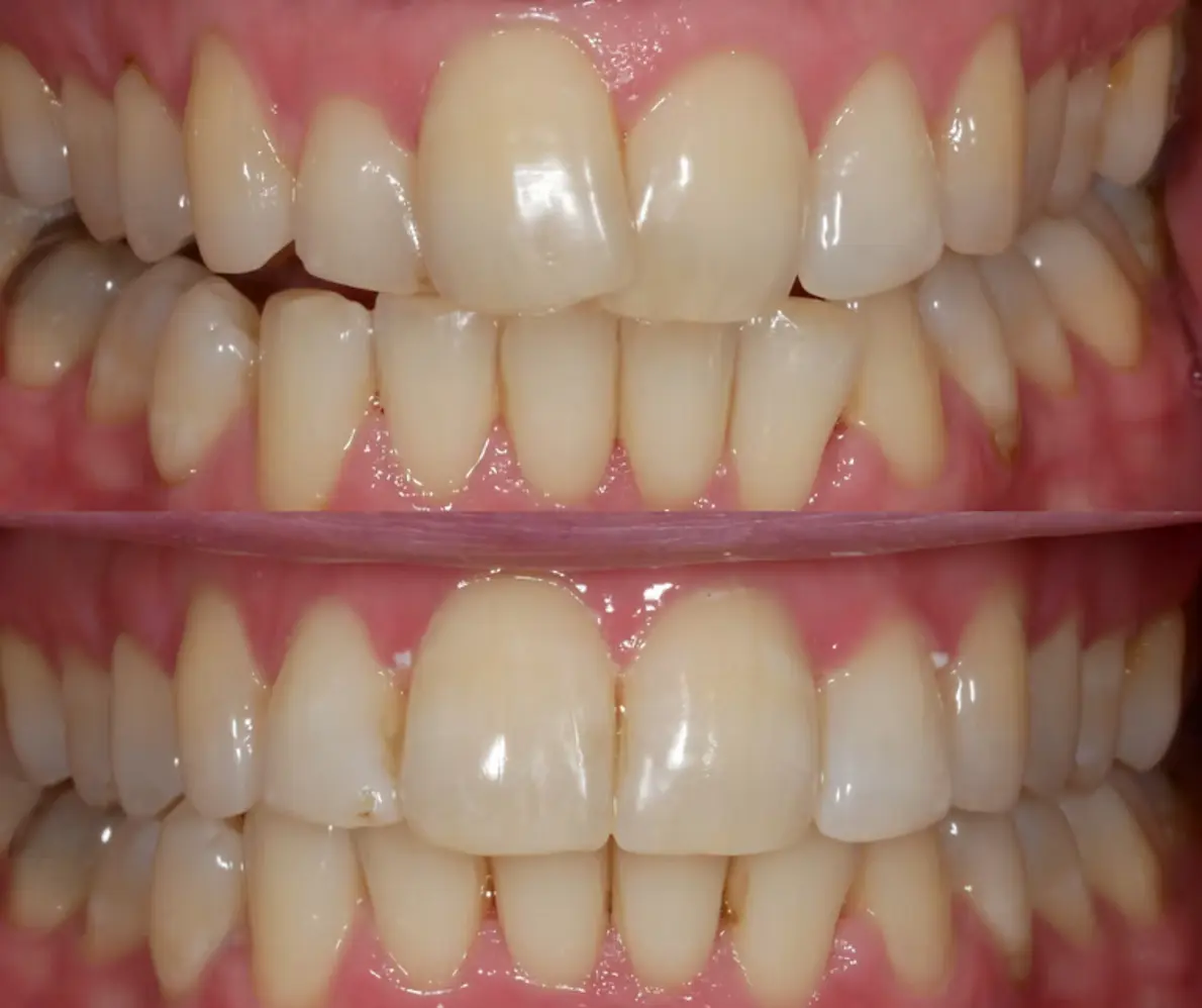 Before and after porcelain veneers with composite bonding at Smile Connections Ivanhoe